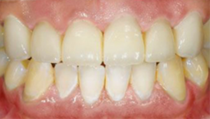 Dental Crowns Case 9 - After