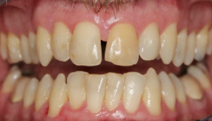 Dental Crowns Case 10 - Before