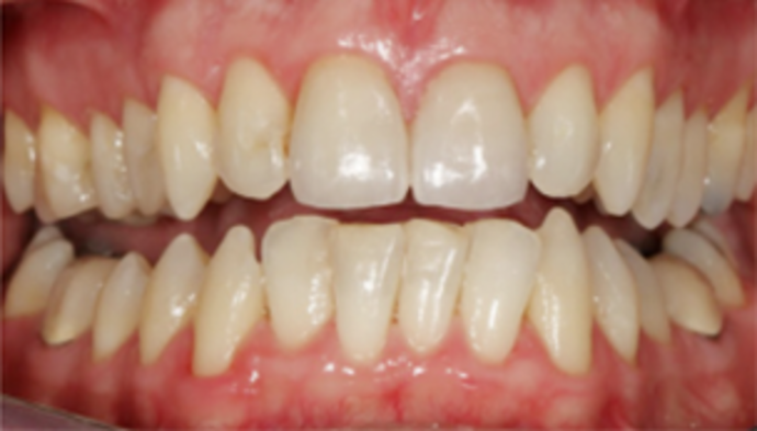 Dental Crowns Case 10 - After