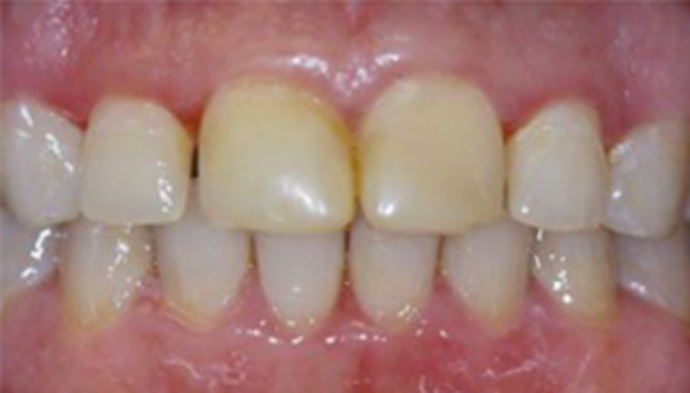 Dental Crowns Case 11 - Before