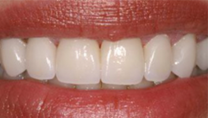 Dental Crowns Case 11 - After
