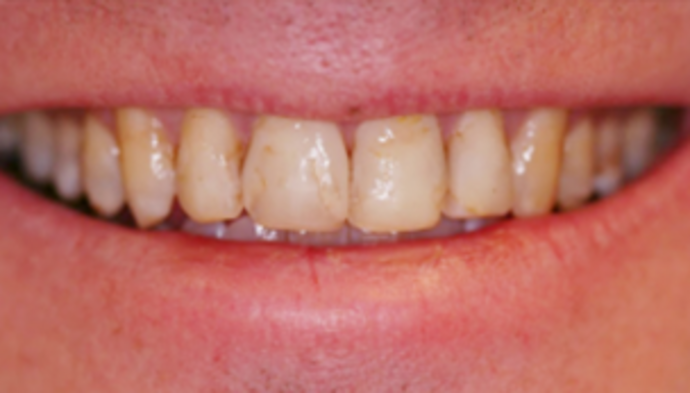 Dental Crowns Case 12 - Before