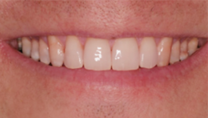 Dental Crowns Case 12 - After