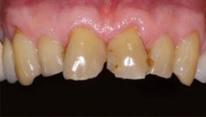 Dental Crowns Case 13 - Before