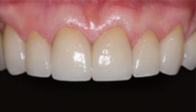Dental Crowns Case 13 - After