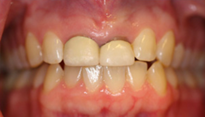 Dental Crowns Case 14 - Before