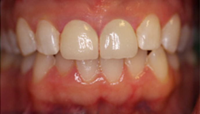 Dental Crowns Case 14 - After