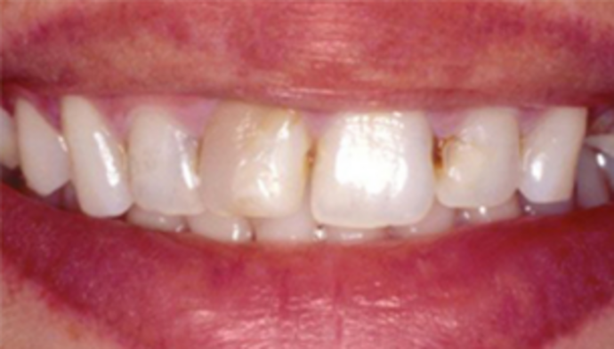 Dental Crowns + Veneers Case 1 - Before