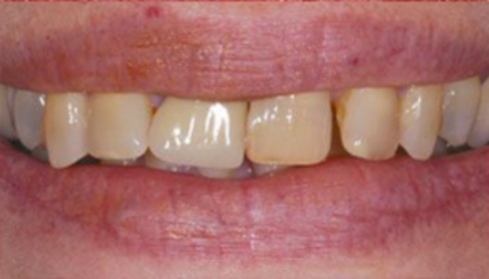 Dental Crowns + Veneers Case 2 - Before