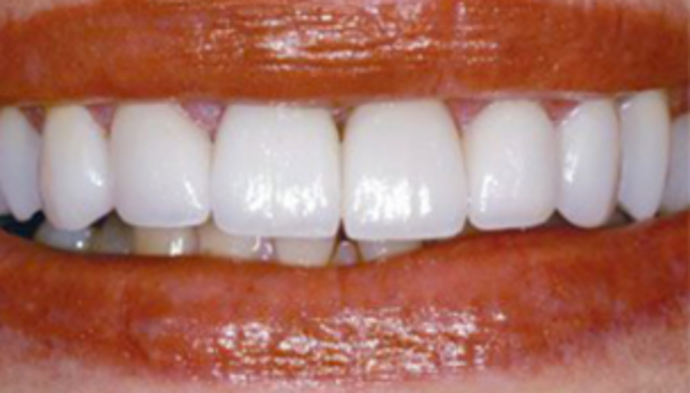 Dental Crowns + Veneers Case 2 - After