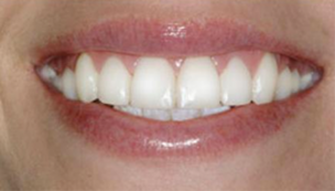 Veneers Cases