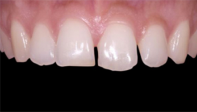 Veneers Case 2 - Before