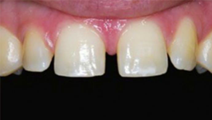 Veneers Case 3 - Before