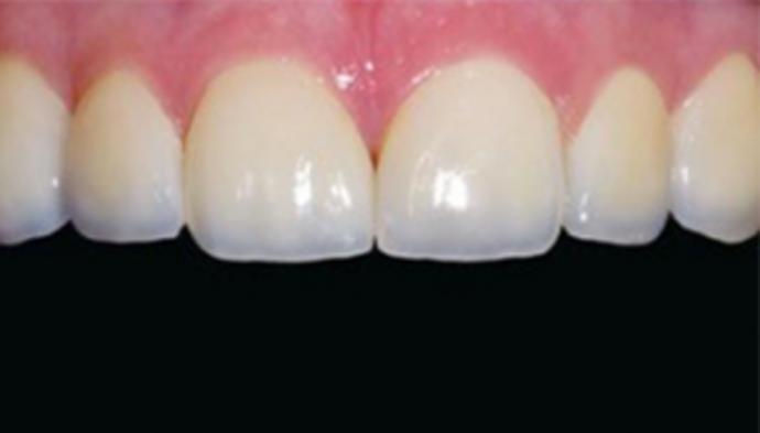 Veneers Case 3 - After