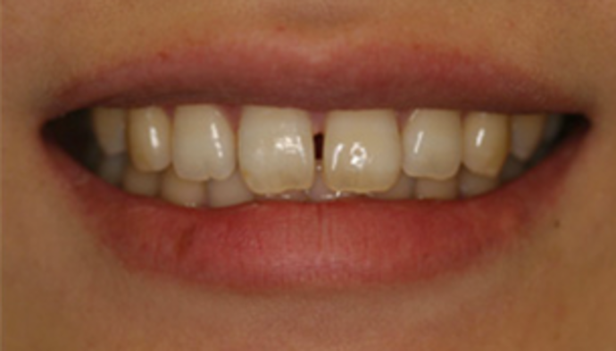 Veneers Case 4 - Before