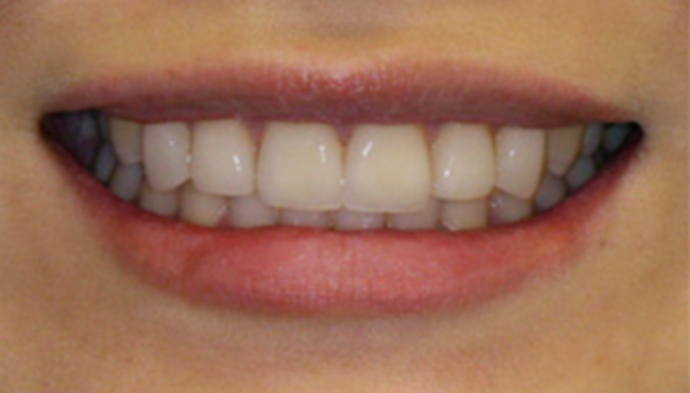 Veneers Case 4 - After