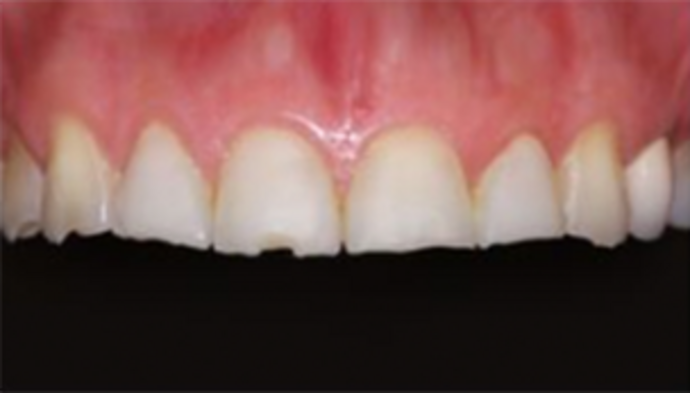 Veneers Case 5 - Before