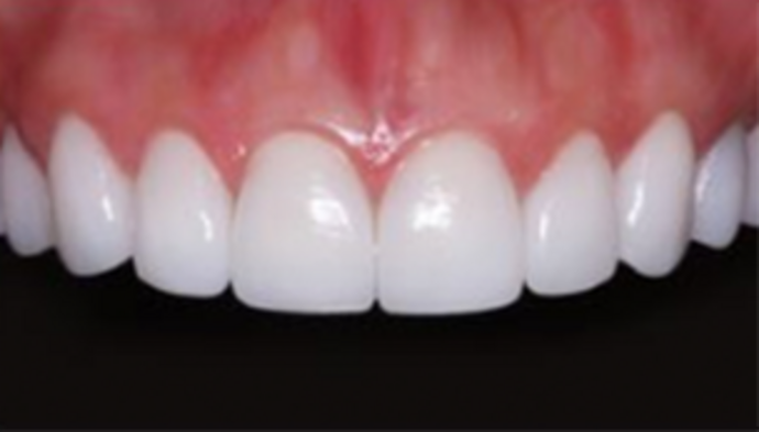Veneers Case 5 - After