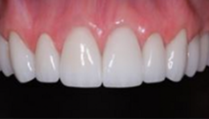 Veneers Case 6 - After