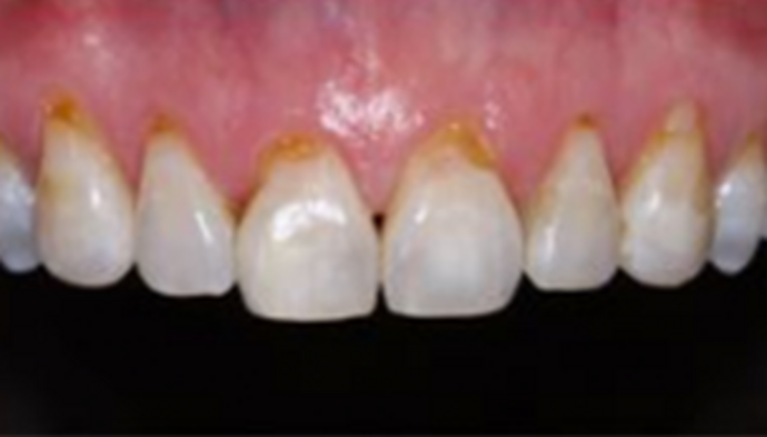 Veneers Case 7 - Before