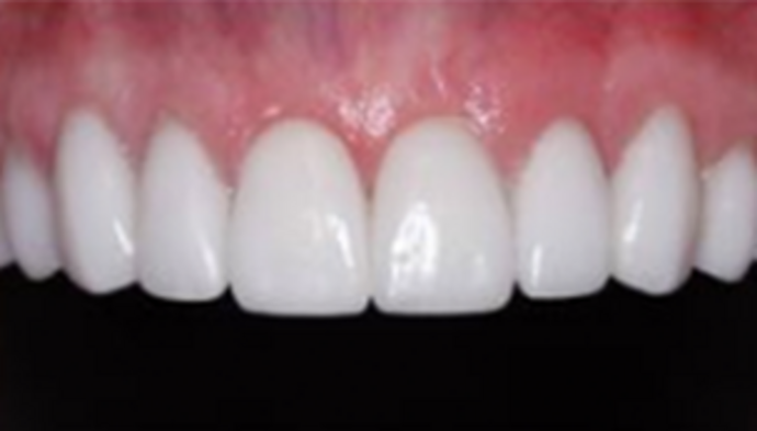 Veneers Case 7 - After