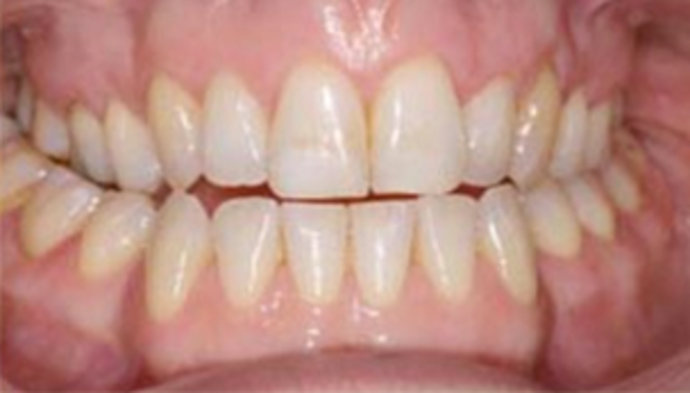 Veneers Case 8 - Before