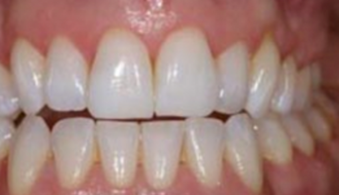Veneers Case 8 - After