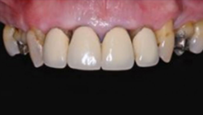 Full Mouth Reconstruction Case 1 - Before