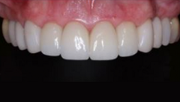 Full Mouth Reconstruction Cases