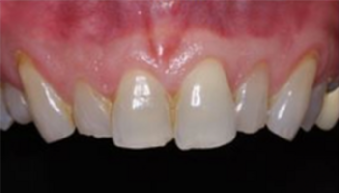 Full Mouth Reconstruction Case 2 - Before