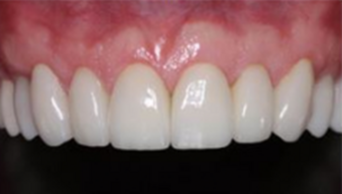 Full Mouth Reconstruction Case 2 - After