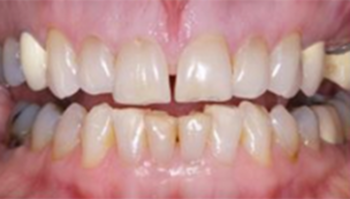 Full Mouth Reconstruction Case 3 - Before