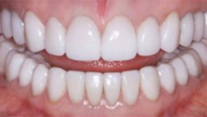 Full Mouth Reconstruction Case 3 - After