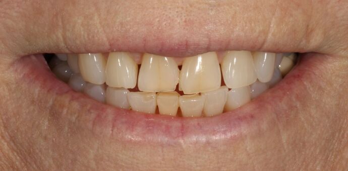 Smile Transformations Case 1 - Before