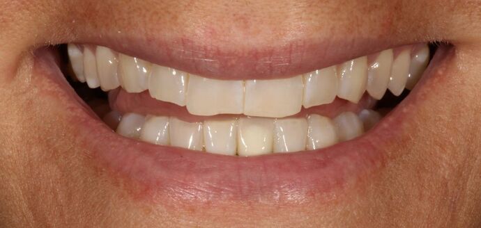 Smile Transformations Case 2 - Before