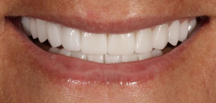 Smile Transformations Case 2 - After