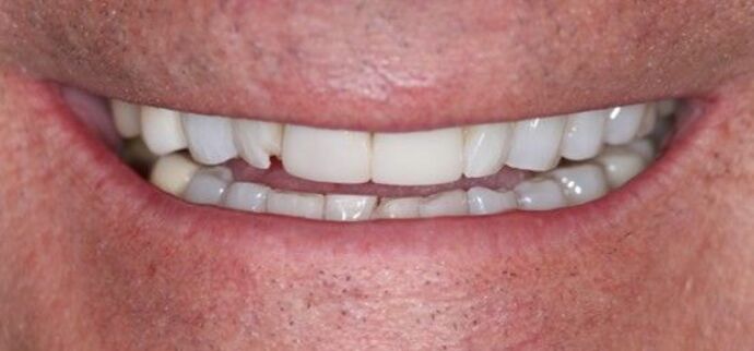 Smile Transformations Case 3 - Before
