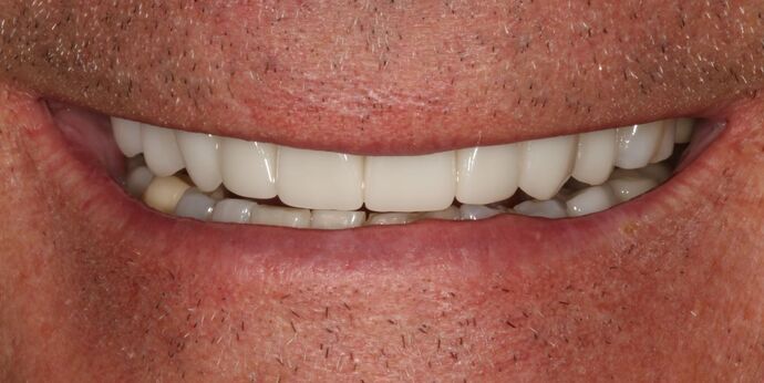 Smile Transformations Case 3 - After