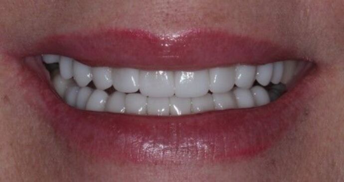 Smile Transformations Case 4 - After