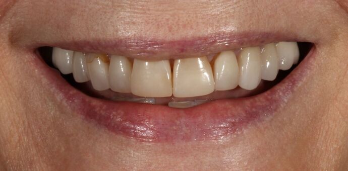 Smile Transformations Case 5 - Before