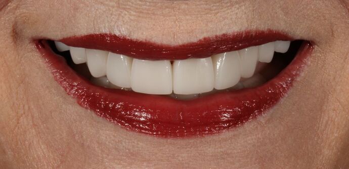 Smile Transformations Case 5 - After