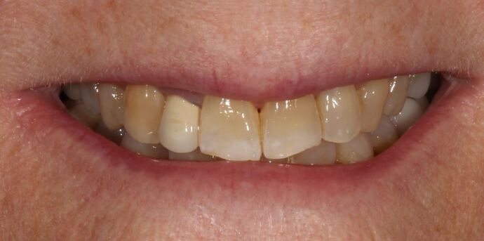 Smile Transformations Case 6 - Before