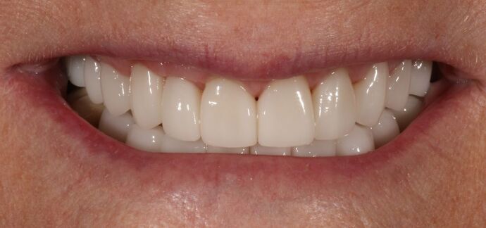Smile Transformations Case 6 - After