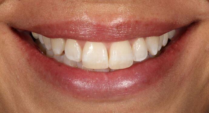 Smile Transformations Case 7 - Before