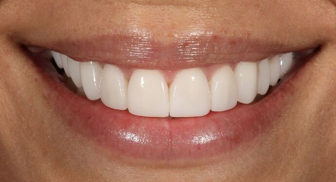 Smile Transformations Case 7 - After
