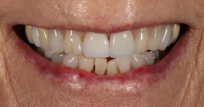Smile Transformations Case 8 - Before