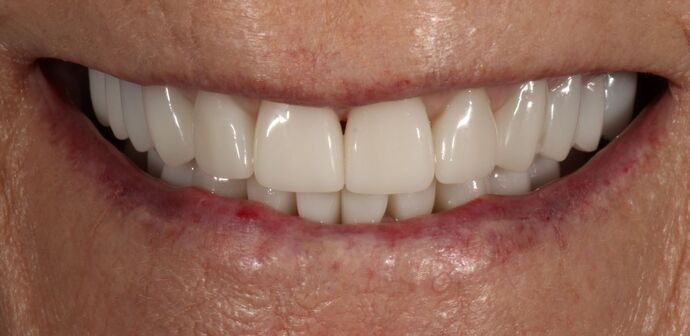 Smile Transformations Case 8 - After