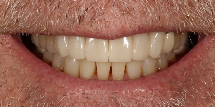 Smile Transformations Case 9 - After