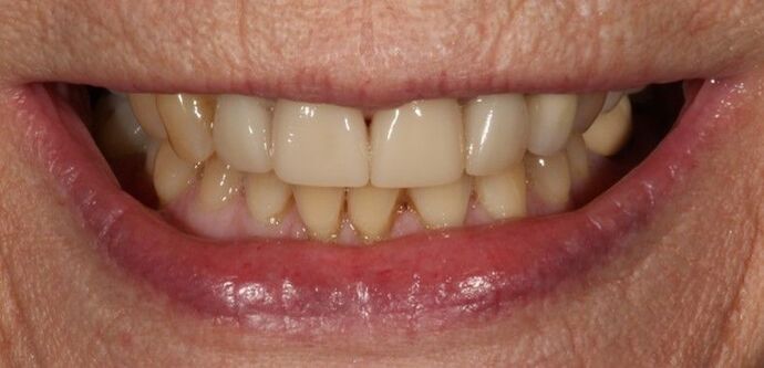 Smile Transformations Case 10 - Before