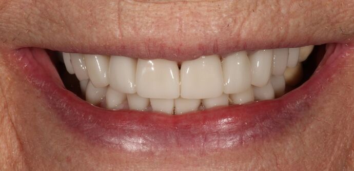 Smile Transformations Case 10 - After